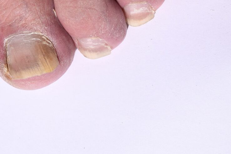المرحلة الأولية من الفطريات من الأظافر على الساقين
