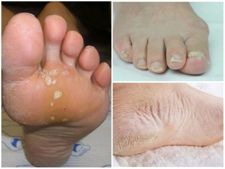 أعراض الفطريات