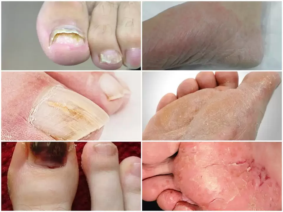 مظاهر الفطريات على القدمين من مسببات الأمراض المختلفة